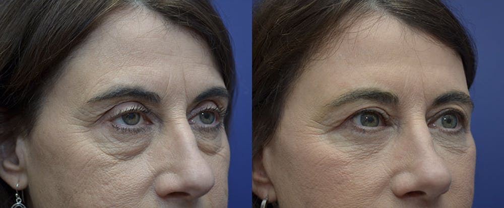 Eyelid Surgery Before & After Gallery - Patient 121814198 - Image 2