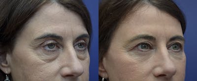 Eyelid Surgery Before & After Gallery - Patient 121814198 - Image 2