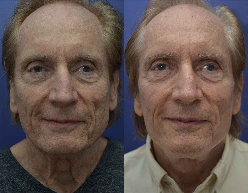 Sculptra Before & After Gallery - Patient 121814208 - Image 1