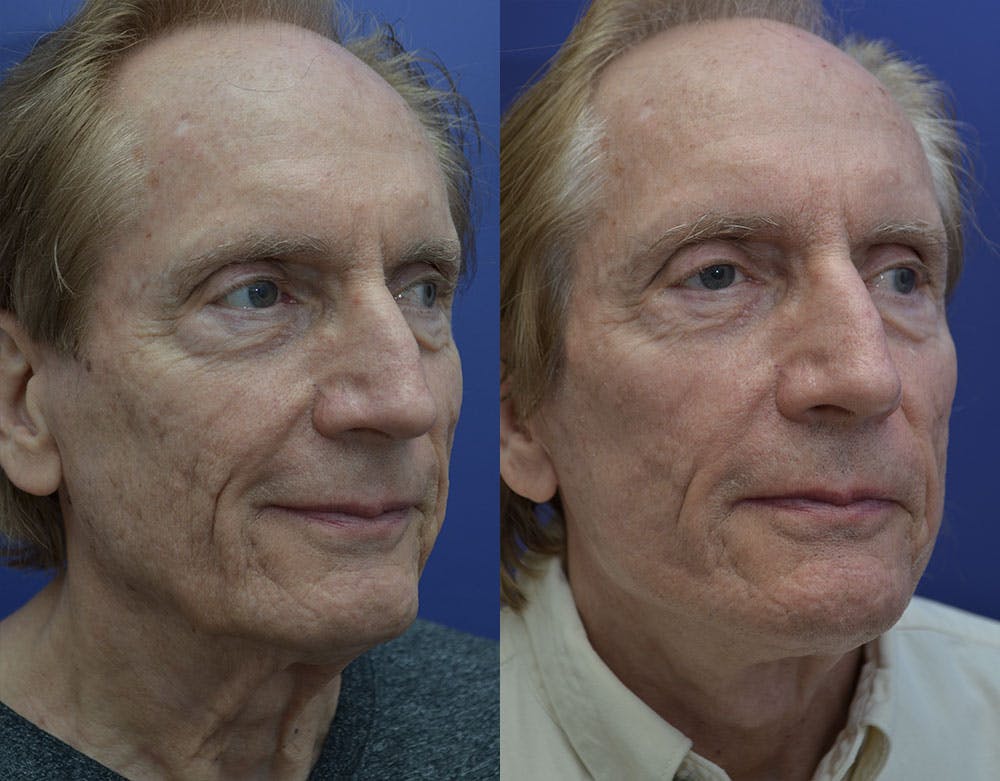 Sculptra Before & After Gallery - Patient 121814208 - Image 3