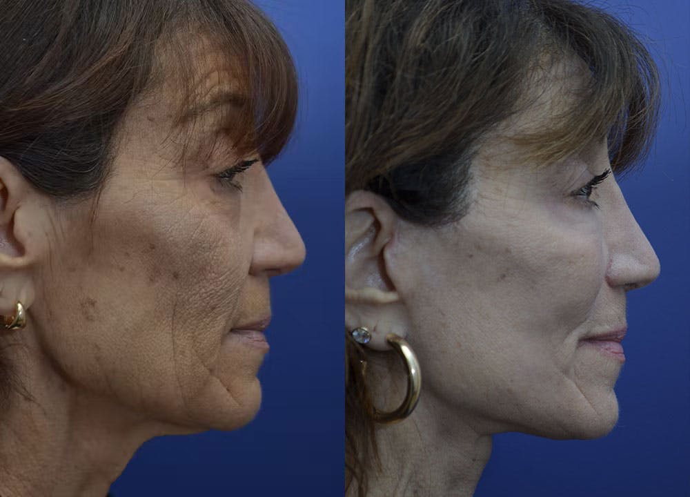 Deep Plane Neck Lift Before & After Gallery - Patient 67335714 - Image 3