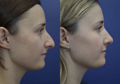 Rhinoplasty (Nose Reshaping) Before & After Gallery - Patient 30353998 - Image 1
