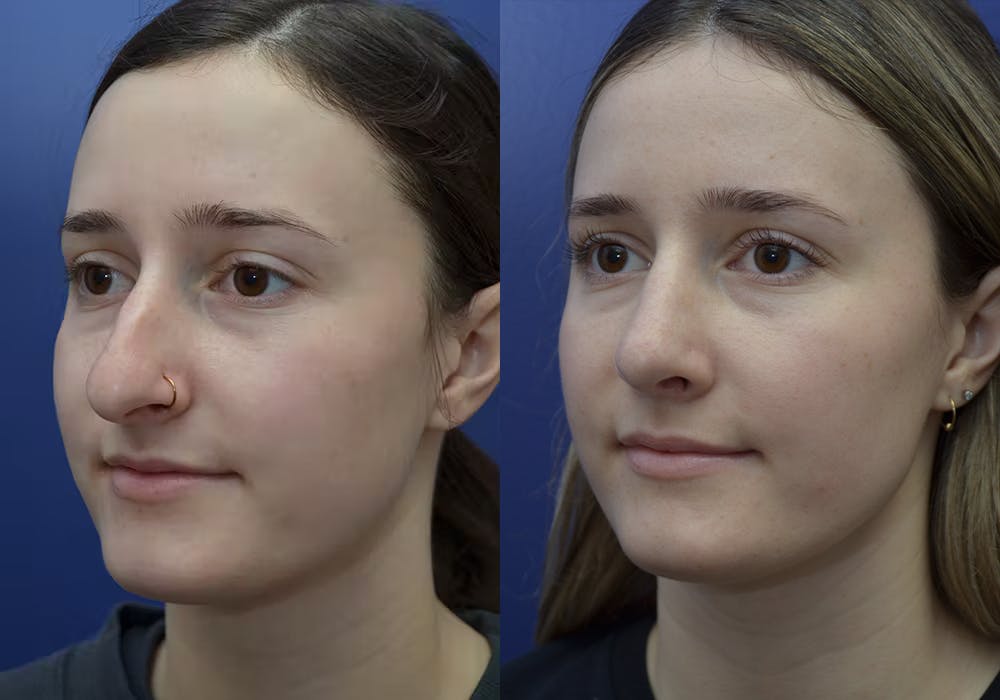 Rhinoplasty (Nose Reshaping) Before & After Gallery - Patient 30353998 - Image 3