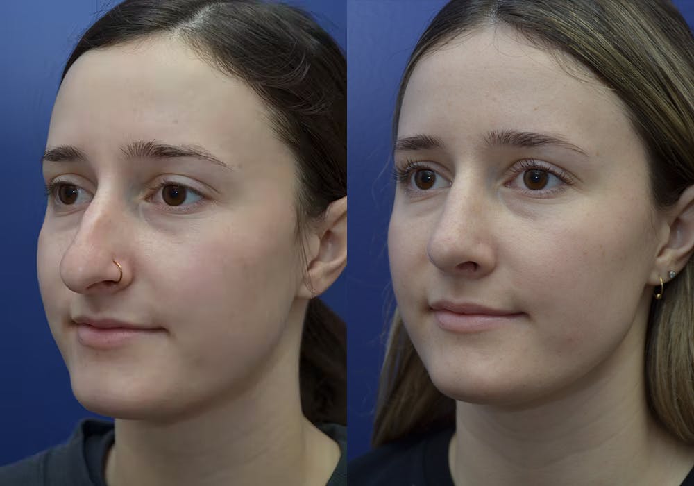 Rhinoplasty (Nose Reshaping) Before & After Gallery - Patient 30353998 - Image 2