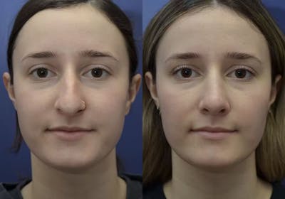 Rhinoplasty (Nose Reshaping) Before & After Gallery - Patient 30353998 - Image 2