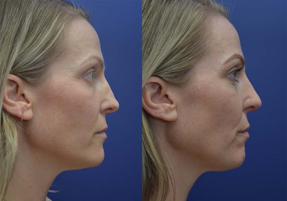 Revision Rhinoplasty Gallery - Patient 122130410 - Image 2