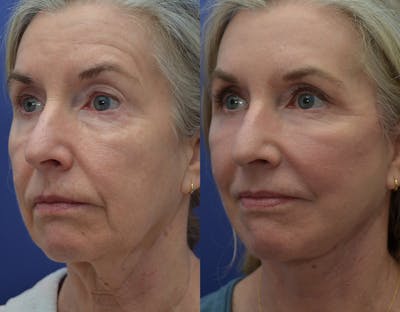 Facelift Before & After Gallery - Patient 122581145 - Image 1