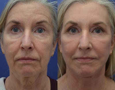 Facelift Before & After Gallery - Patient 122581145 - Image 2