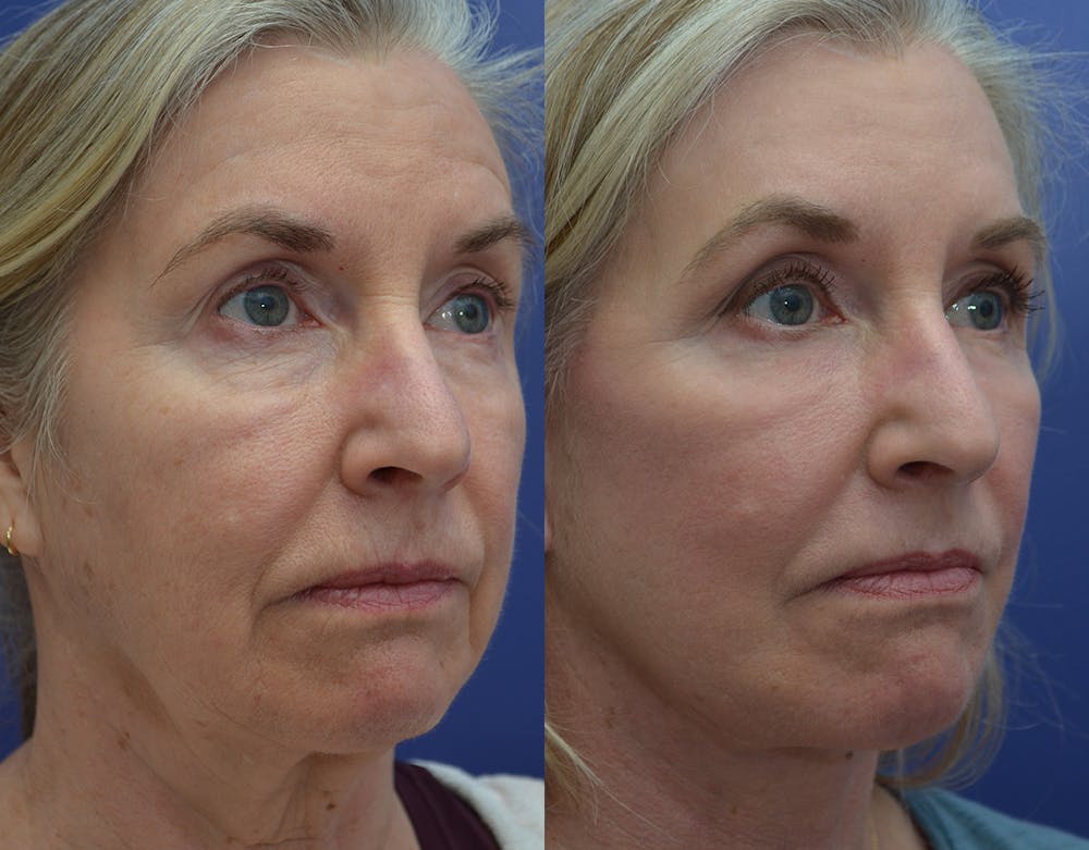 Facelift Before & After Gallery - Patient 122581145 - Image 4