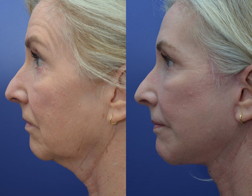 Facelift Before & After Gallery - Patient 122581145 - Image 5