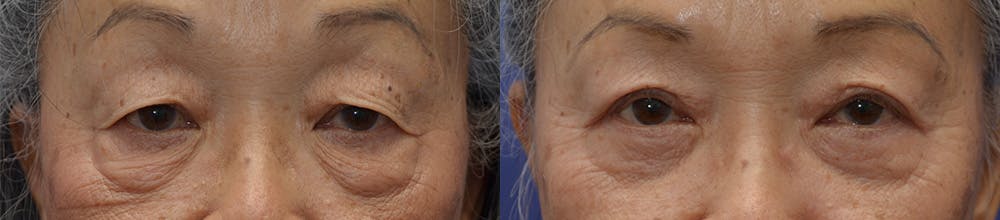 Upper Eyelid Ptosis Repair Before & After Gallery - Patient 122581291 - Image 1