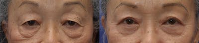 Upper Eyelid Ptosis Repair Before & After Gallery - Patient 122581291 - Image 1