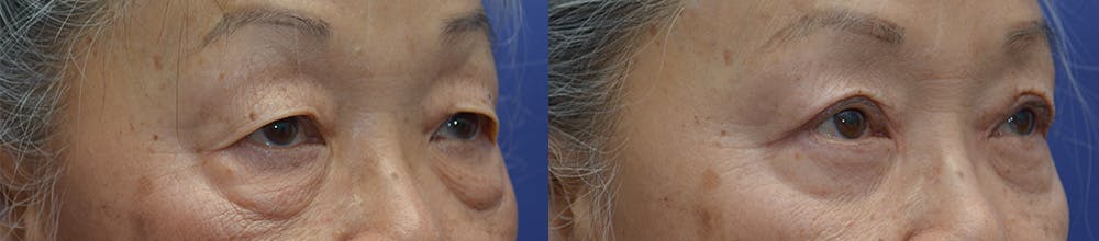 Upper Eyelid Ptosis Repair Before & After Gallery - Patient 122581291 - Image 2