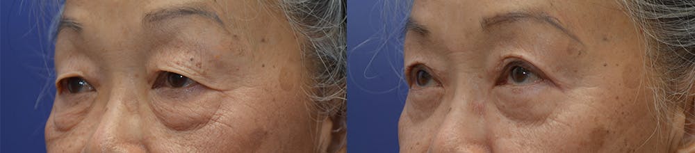 Upper Eyelid Ptosis Repair Before & After Gallery - Patient 122581291 - Image 3