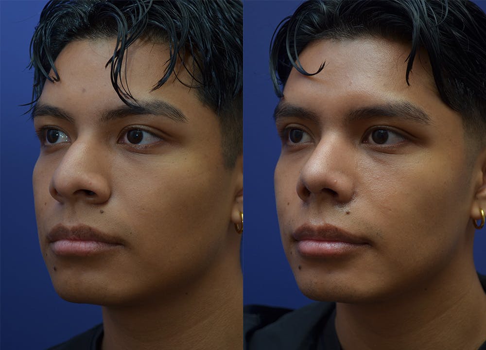Rhinoplasty (Nose Reshaping) Before & After Gallery - Patient 123887615 - Image 2