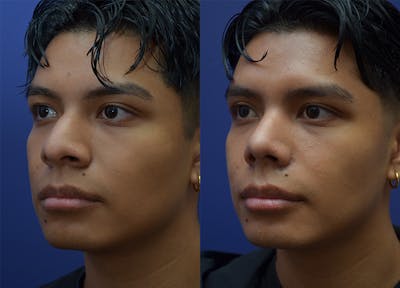 Rhinoplasty (Nose Reshaping) Gallery - Patient 123887615 - Image 2
