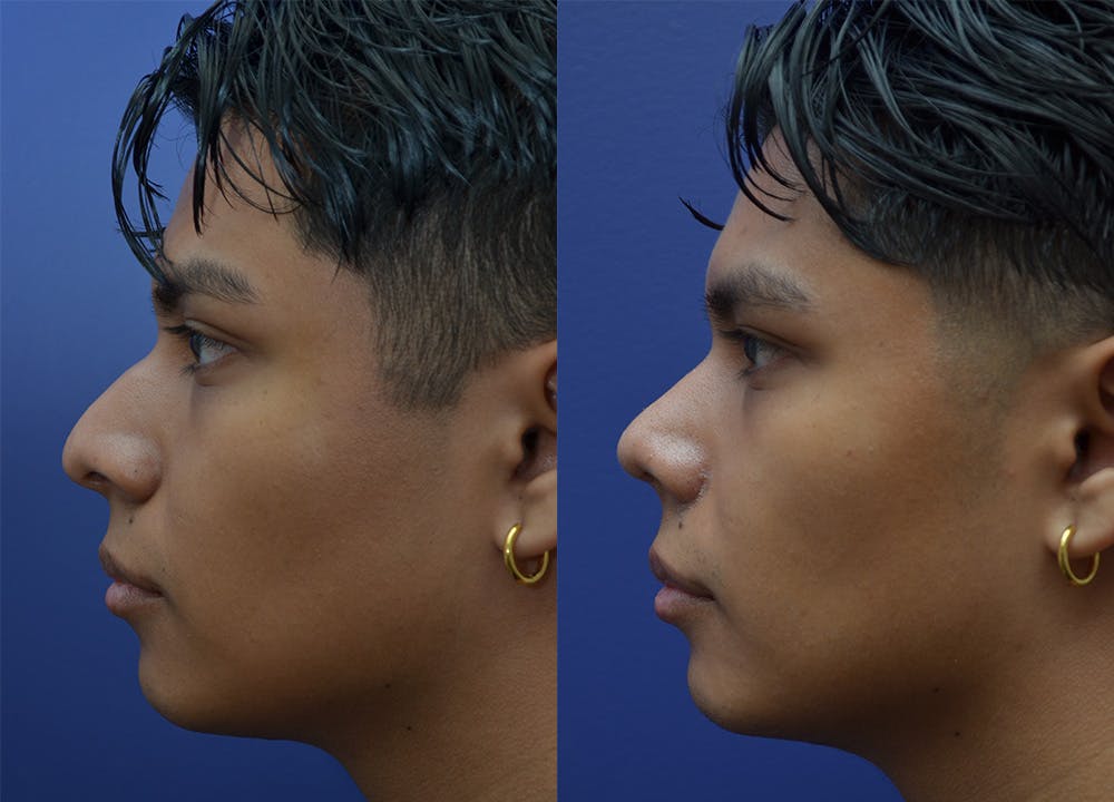 Rhinoplasty (Nose Reshaping) Before & After Gallery - Patient 123887615 - Image 1