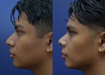 Rhinoplasty (Nose Reshaping) Before & After Gallery - Patient 123887615 - Image 1