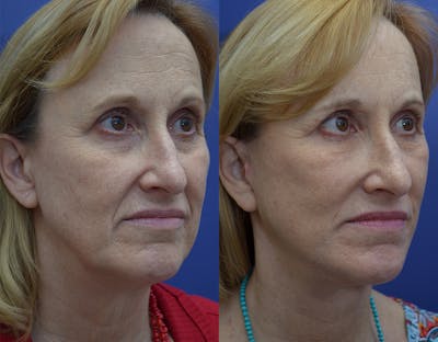 Facial Revolumizing (Fat Transfer) Before & After Gallery - Patient 123887634 - Image 1