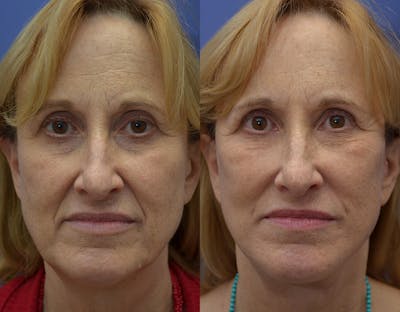 Deep Plane Facelift Before & After Gallery - Patient 123887631 - Image 2