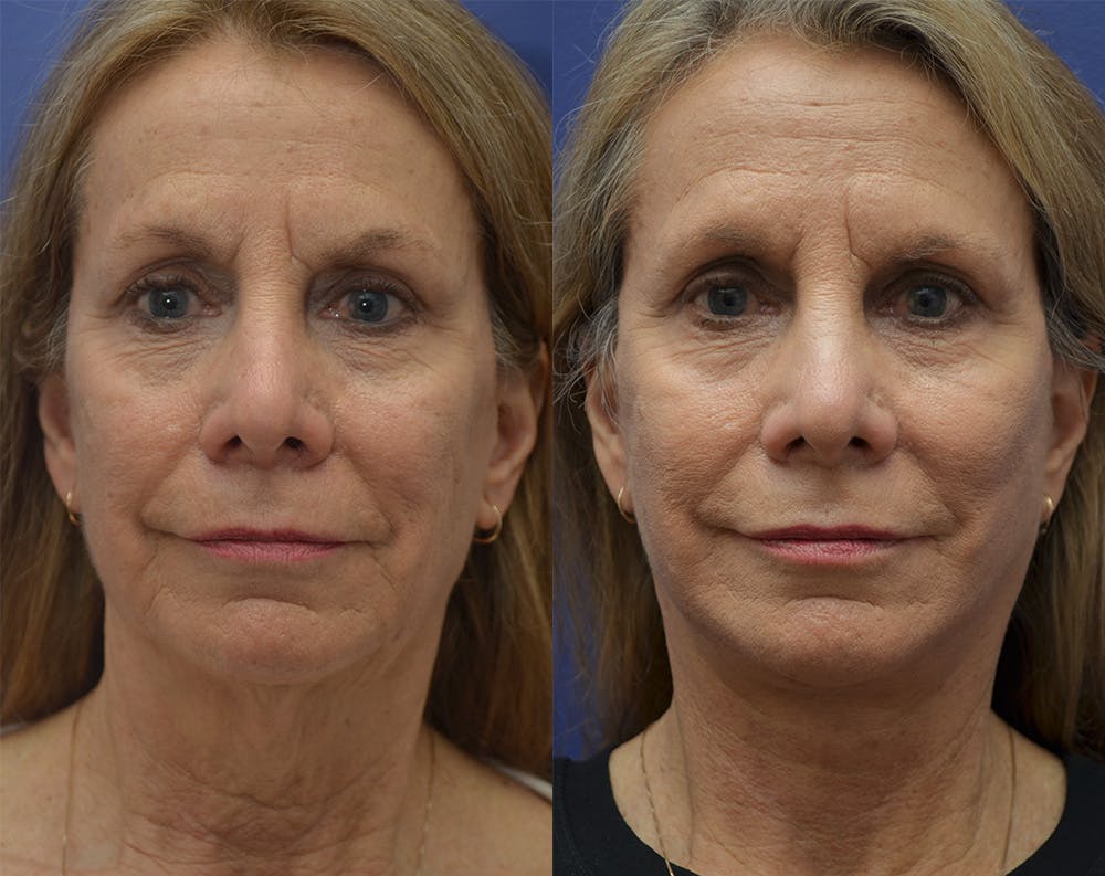 Deep Plane Neck Lift Before & After Gallery - Patient 140400384 - Image 5