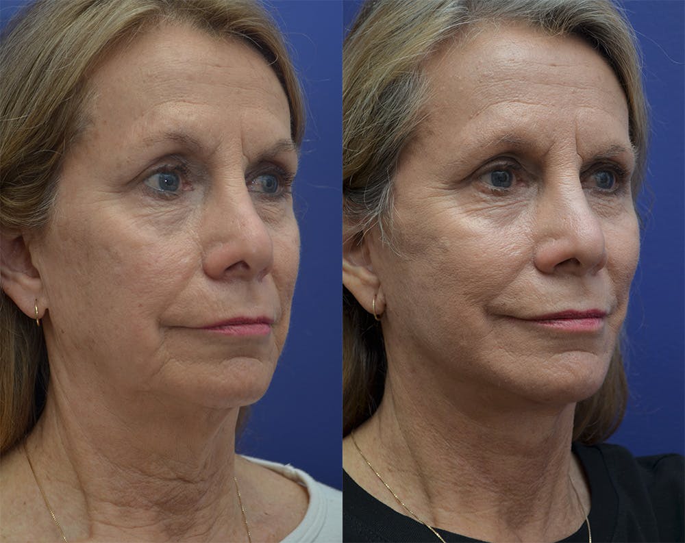 Deep Plane Neck Lift Before & After Gallery - Patient 140400384 - Image 4