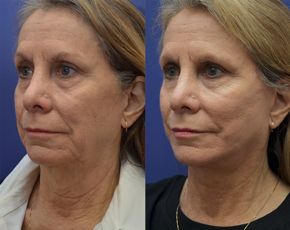 Deep Plane Neck Lift Before & After Gallery - Patient 140400384 - Image 3