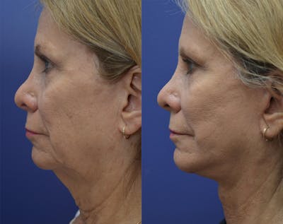 Deep Plane Neck Lift Before & After Gallery - Patient 140400384 - Image 2