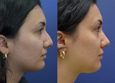 Rhinoplasty (Nose Reshaping) Before & After Gallery - Patient 140400437 - Image 1