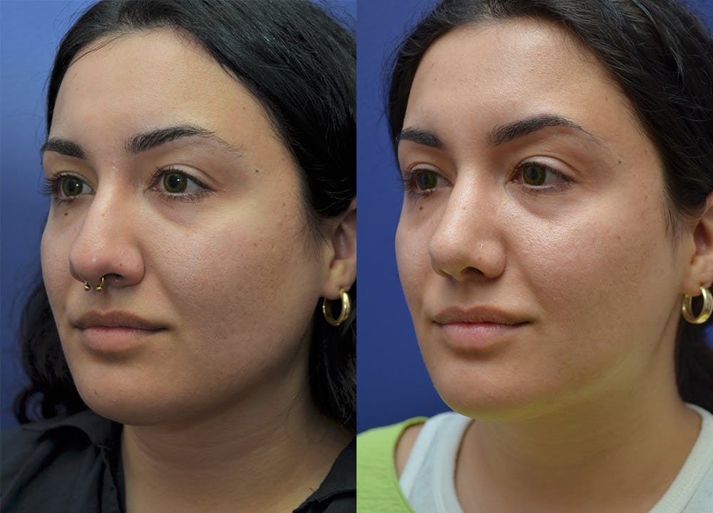 Rhinoplasty (Nose Reshaping) Gallery - Patient 140400437 - Image 3