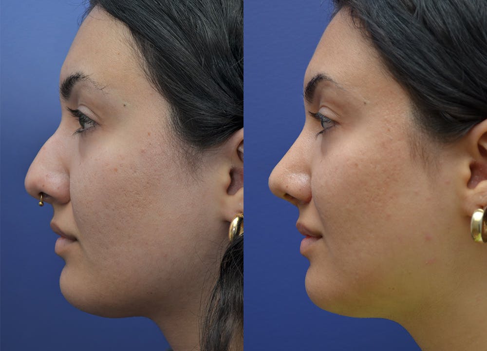 Rhinoplasty (Nose Reshaping) Before & After Gallery - Patient 140400437 - Image 2