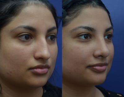 Rhinoplasty (Nose Reshaping) Before & After Gallery - Patient 141526208 - Image 1
