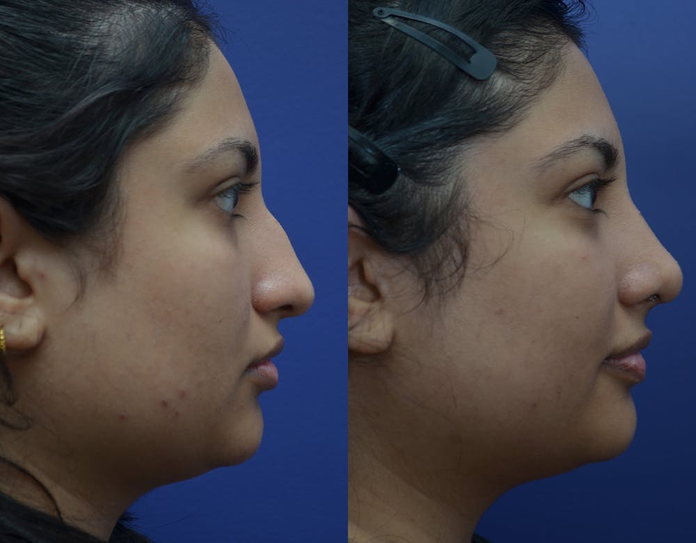 Rhinoplasty (Nose Reshaping) Before & After Gallery - Patient 141526208 - Image 2