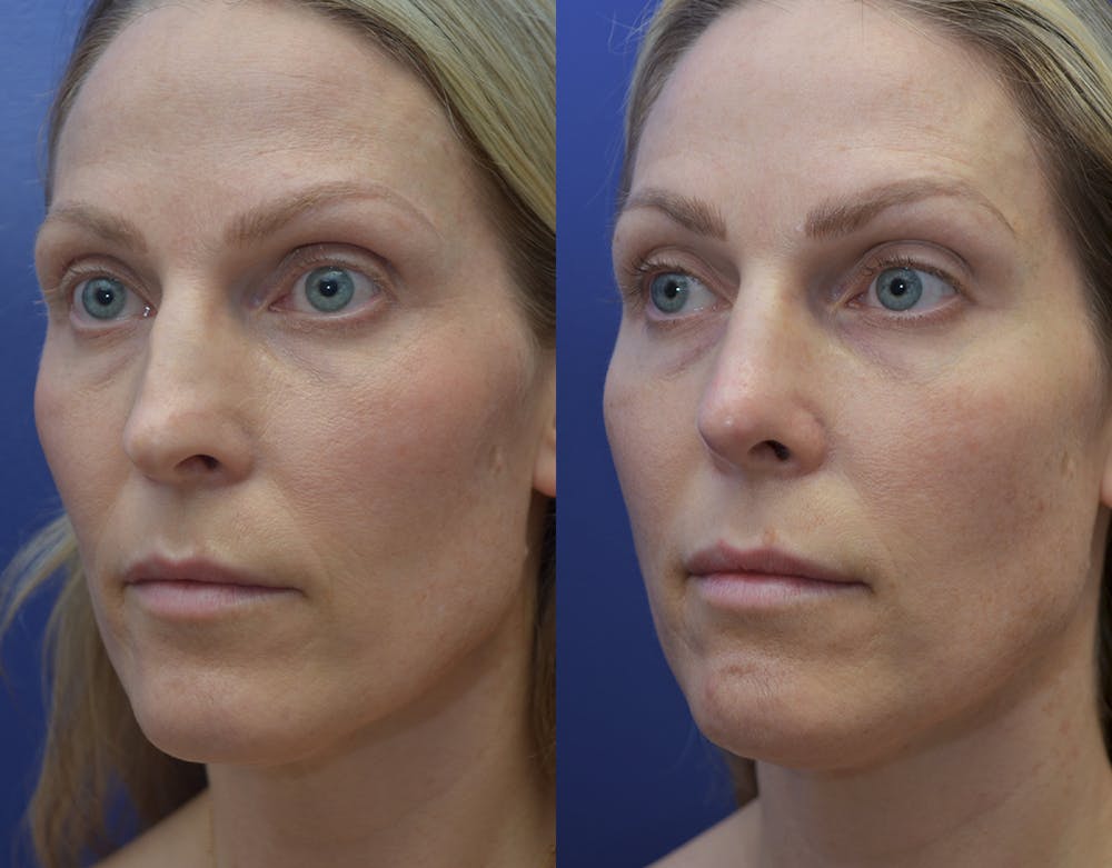 Revision Rhinoplasty Before & After Gallery - Patient 141527189 - Image 4