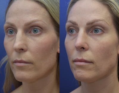 Revision Rhinoplasty Before & After Gallery - Patient 141527189 - Image 4