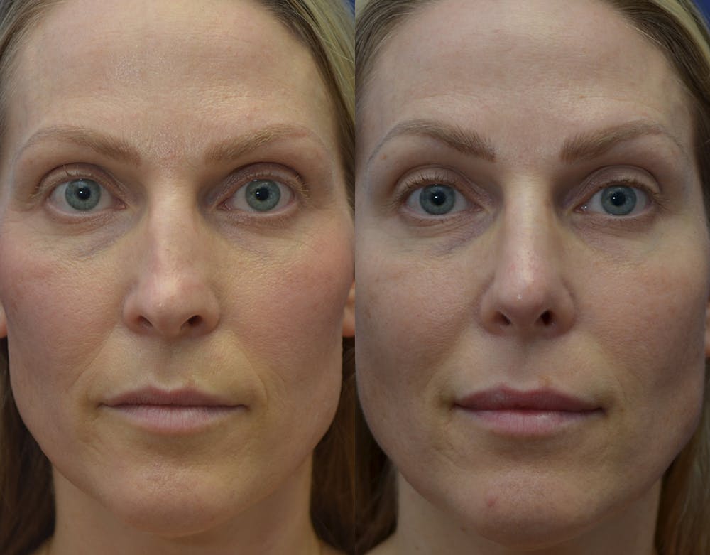 Revision Rhinoplasty Before & After Gallery - Patient 141527189 - Image 5