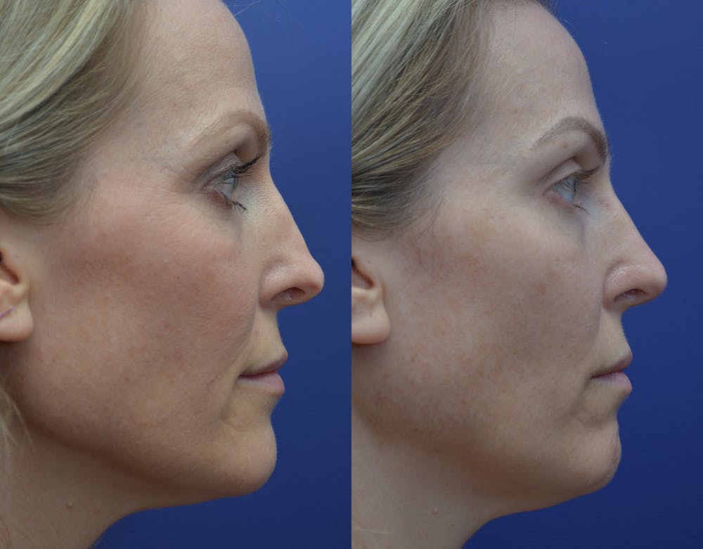 Revision Rhinoplasty Before & After Gallery - Patient 141527189 - Image 1