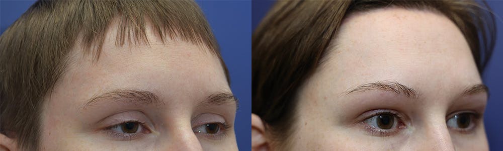 Upper Eyelid Ptosis Repair Before & After Gallery - Patient 144637585 - Image 3