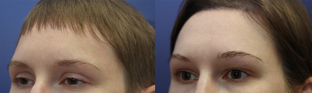 Upper Eyelid Ptosis Repair Before & After Gallery - Patient 144637585 - Image 2