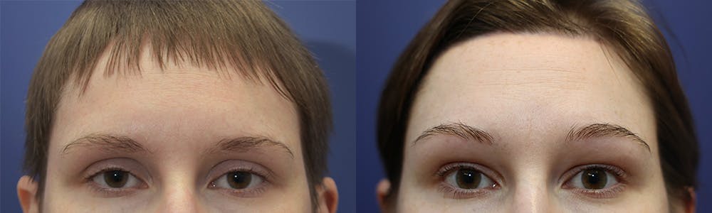 Upper Eyelid Ptosis Repair Before & After Gallery - Patient 144637585 - Image 1