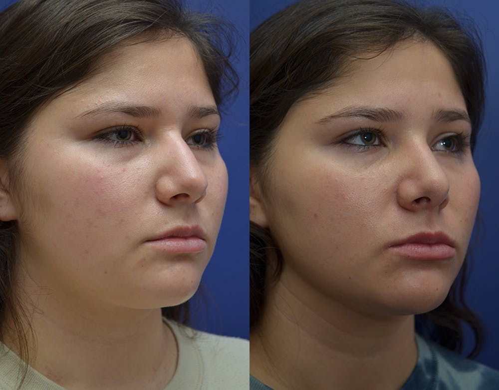 Rhinoplasty (Nose Reshaping) Before & After Gallery - Patient 144637597 - Image 1