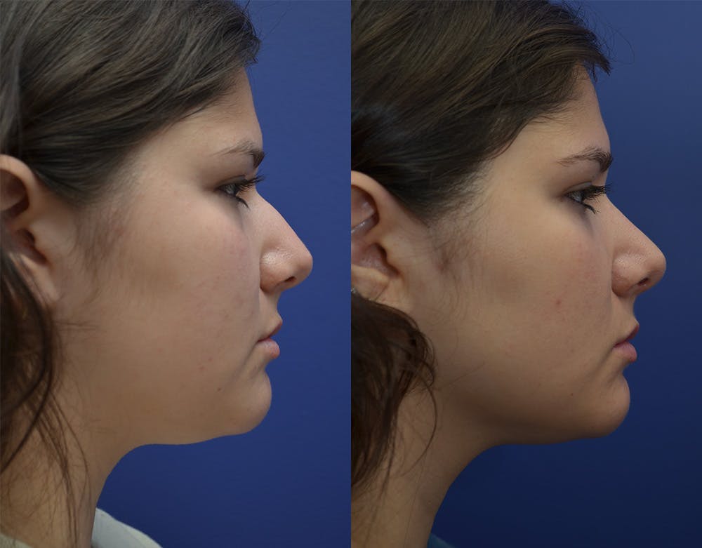 Rhinoplasty (Nose Reshaping) Before & After Gallery - Patient 144637597 - Image 2
