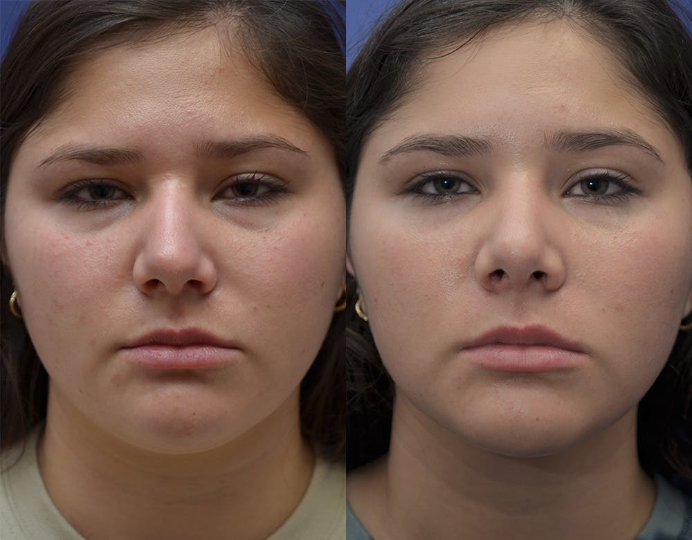 Rhinoplasty (Nose Reshaping) Before & After Gallery - Patient 144637597 - Image 3