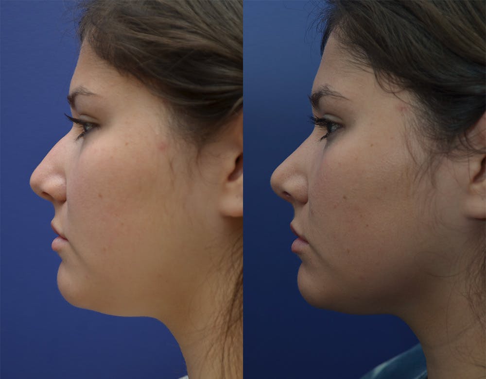 Rhinoplasty (Nose Reshaping) Before & After Gallery - Patient 144637597 - Image 4