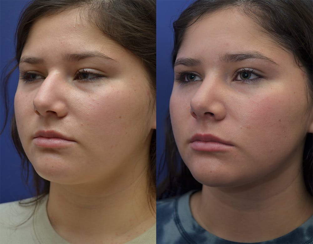 Rhinoplasty (Nose Reshaping) Before & After Gallery - Patient 144637597 - Image 5