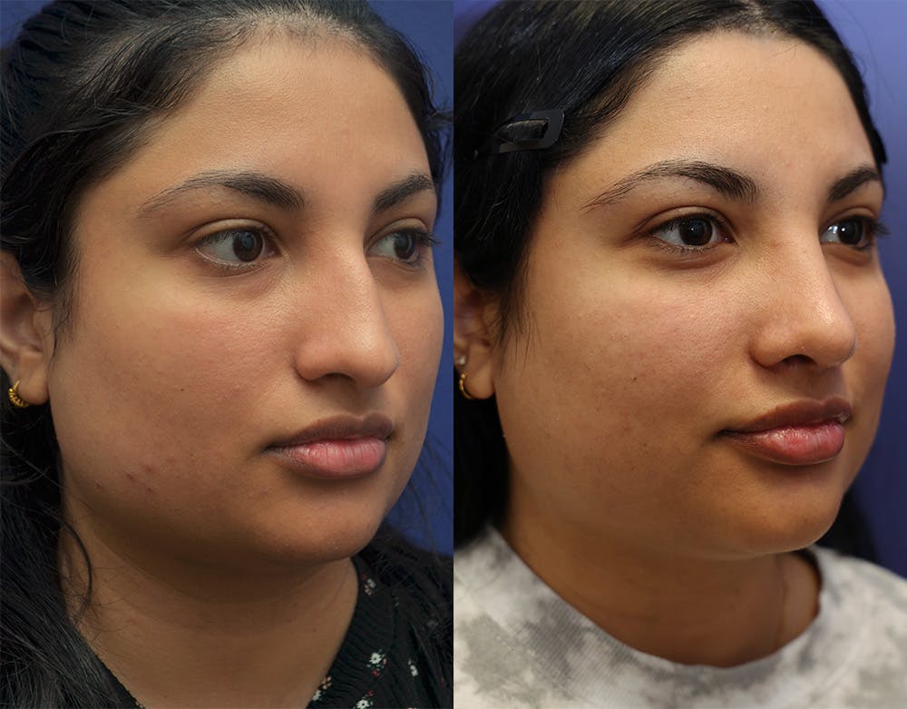 Rhinoplasty (Nose Reshaping) Before & After Gallery - Patient 141526208 - Image 1