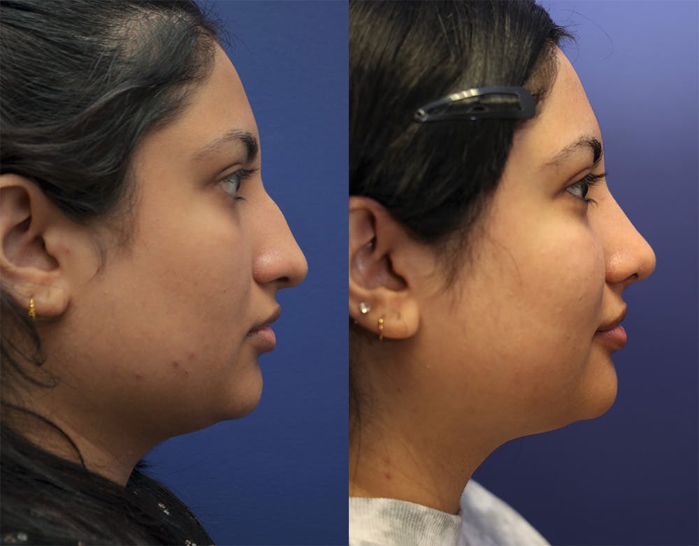 Rhinoplasty (Nose Reshaping) Before & After Gallery - Patient 141526208 - Image 2