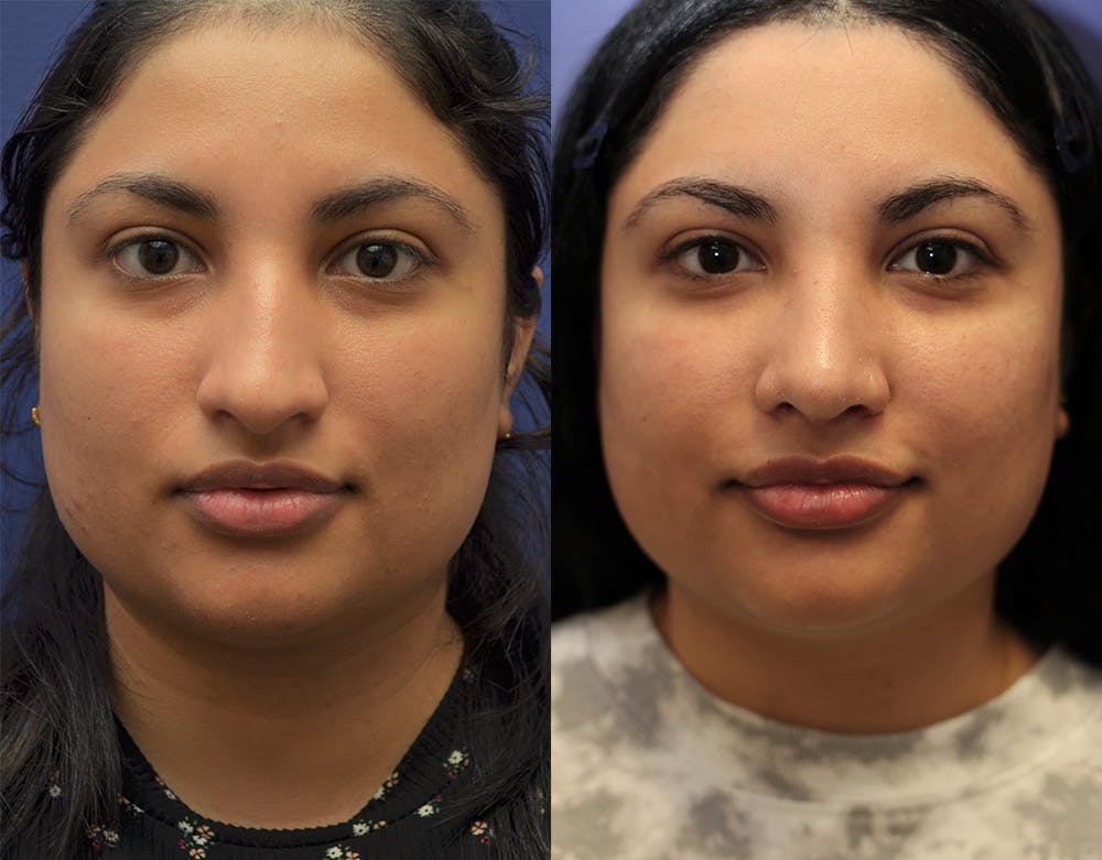 Rhinoplasty (Nose Reshaping) Before & After Gallery - Patient 141526208 - Image 3