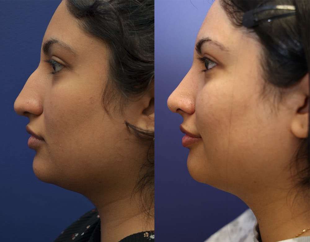 Rhinoplasty (Nose Reshaping) Before & After Gallery - Patient 141526208 - Image 4