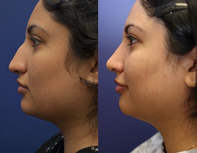 Rhinoplasty (Nose Reshaping) Before & After Gallery - Patient 141526208 - Image 4